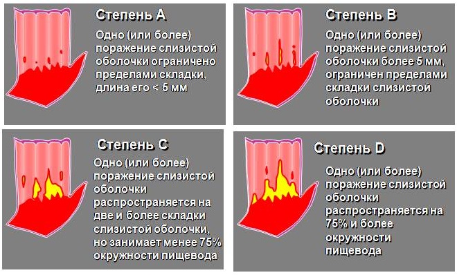 Эзофагит. Симптомы и лечение медикаментозное, диета