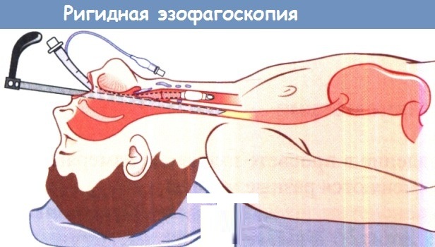 Эзофагит. Симптомы и лечение медикаментозное, диета