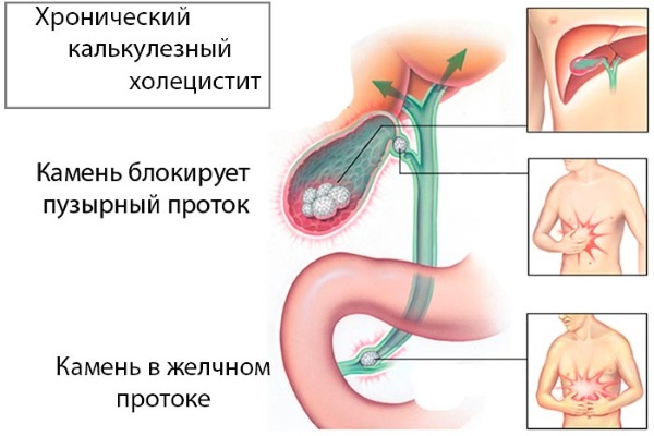 Обострение хронического холецистита. Лечение, симптомы, что провоцирует, диета