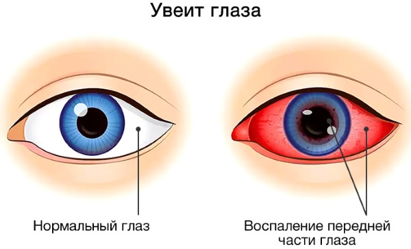 Инородное тело в глазу. Первая помощь, куда обратиться, капли