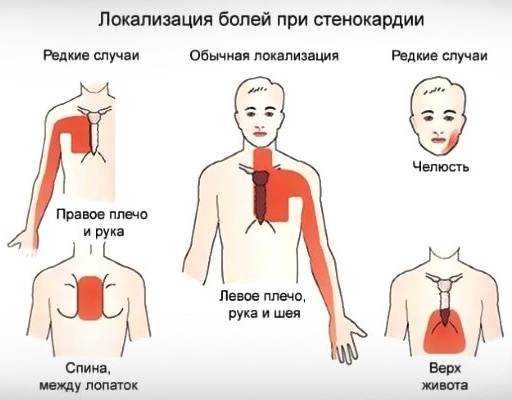 Ишемическая болезнь сердца. Симптомы и лечение, признаки, рекомендации