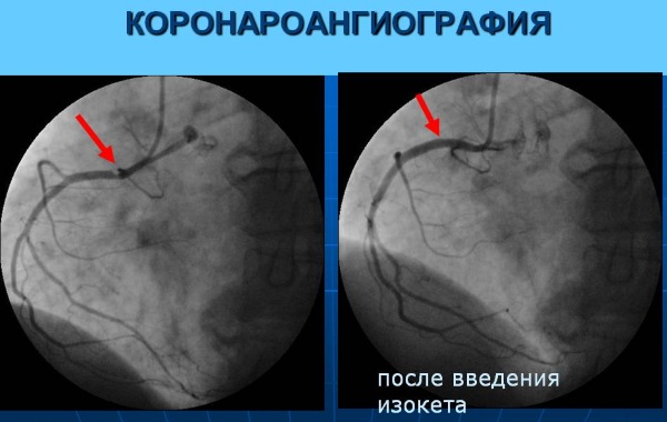 Ишемическая болезнь сердца. Симптомы и лечение, признаки, рекомендации