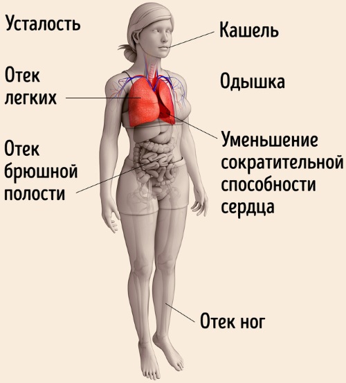 Ишемическая болезнь сердца. Симптомы и лечение, признаки, рекомендации