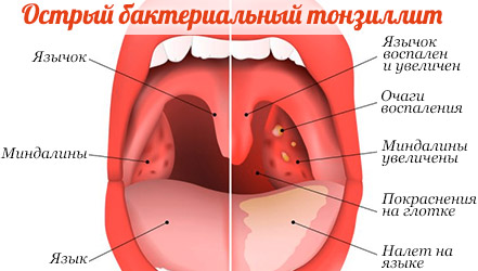 Красное горло у детей фото