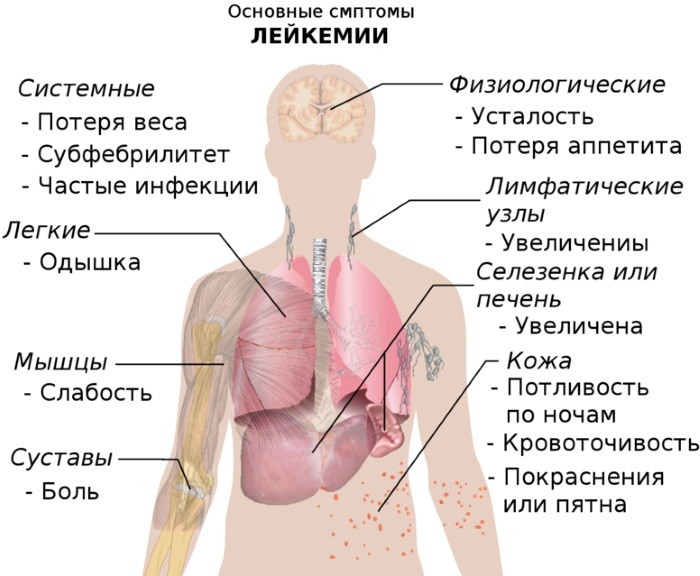 Лейкемия. Симптомы у взрослых, детей, анализ крови, лечение народными средствами, препаратами