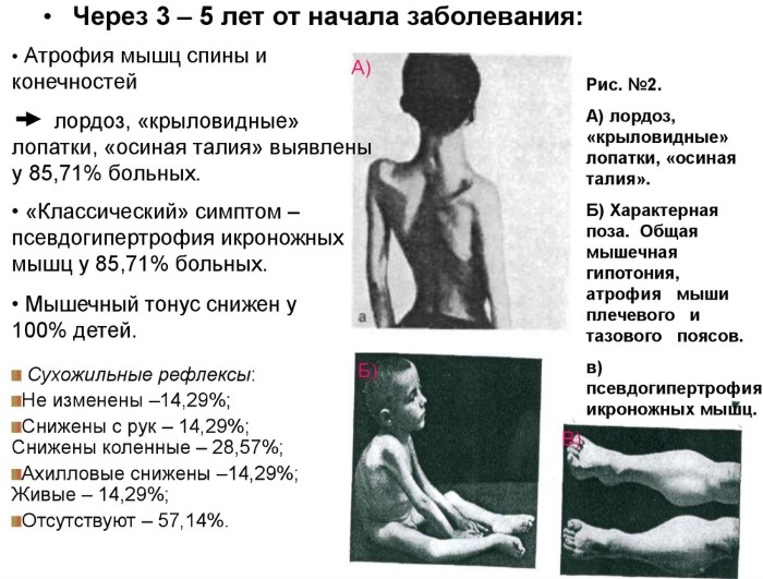 Нервно-мышечные заболевания. Классификация, этиология, неврология, наследственные, хронические. Симптомы и лечение у детей, взрослых