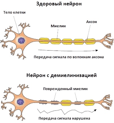 Нервно-мышечные заболевания. Классификация, этиология, неврология, наследственные, хронические. Симптомы и лечение у детей, взрослых