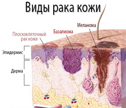 Новообразования на коже лица, руки, шеи, ягодиц, стопы ноги, головы. Виды, причины, удаление лазером