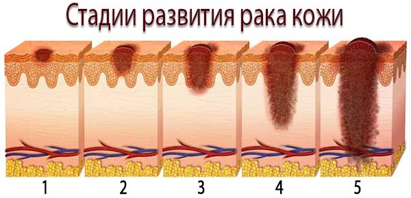 Новообразования на коже лица, руки, шеи, ягодиц, стопы ноги, головы. Виды, причины, удаление лазером