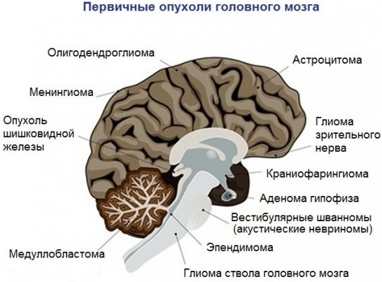 Опухоль в голове. Симптомы у взрослого, ребенка на ранней стадии, как определить, к какому врачу обратиться
