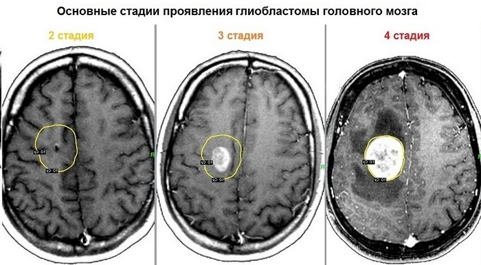 Опухоль в голове. Симптомы у взрослого, ребенка на ранней стадии, как определить, к какому врачу обратиться