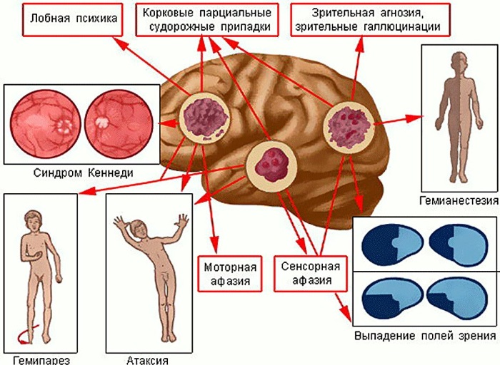 Опухоль в голове. Симптомы у взрослого, ребенка на ранней стадии, как определить, к какому врачу обратиться