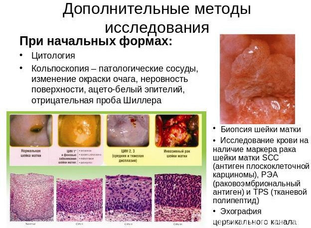 Плоскоклеточная карцинома шейки матки с тенденцией к ороговению. Что это такое, симптомы, прогноз, лечение