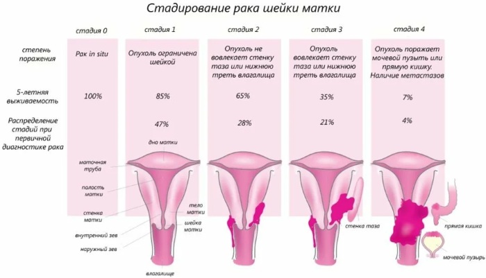 Плоскоклеточная карцинома шейки матки с тенденцией к ороговению. Что это такое, симптомы, прогноз, лечение