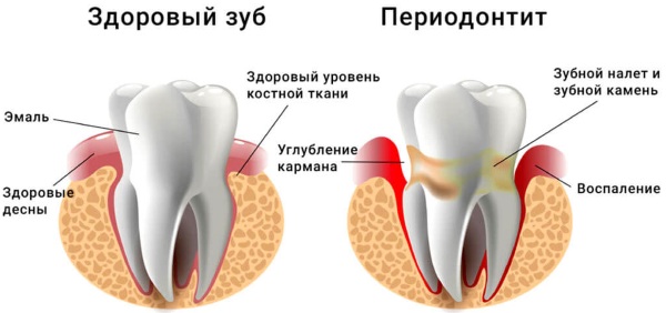 Привкус крови во рту. Причины у женщин, мужчин по утрам после кашля, бега, еды, сна, как избавиться