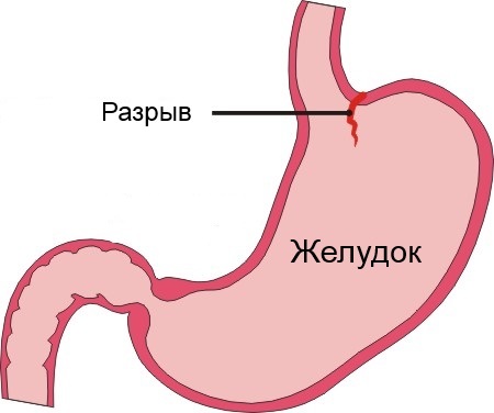 Синдром Маллори-Вейсса. Что это такое, причины, клинические рекомендации, диагностика, лечение