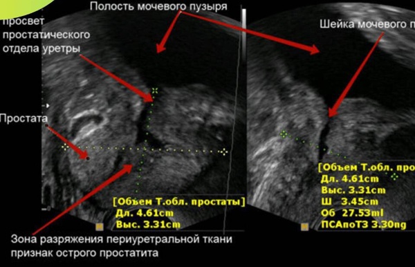 Трузи предстательной железы фото