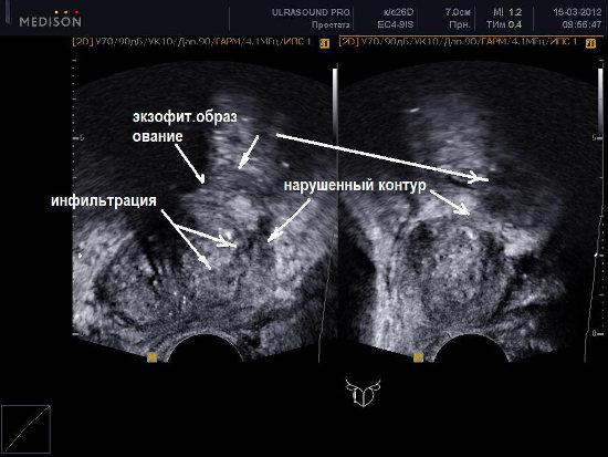 Трузи предстательной железы фото