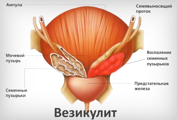 Урологические заболевания у мужчин. Симптомы и лечение болезней