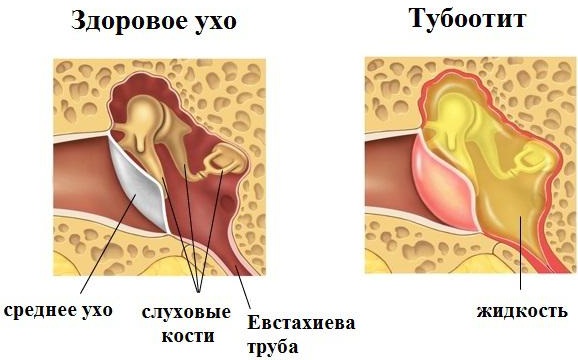 Тубоотит. Симптомы и лечение у детей, взрослого, клинические рекомендации