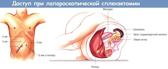 Удаление селезенки. Последствия для организма, как называется операция, диета, реабилитация