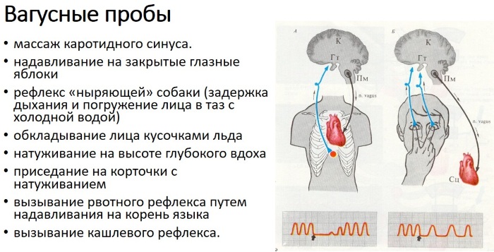 Вагусные пробы при тахикардии, аритмии, экстрасистолии, ВПВ у взрослых. Что это такое, противопоказания
