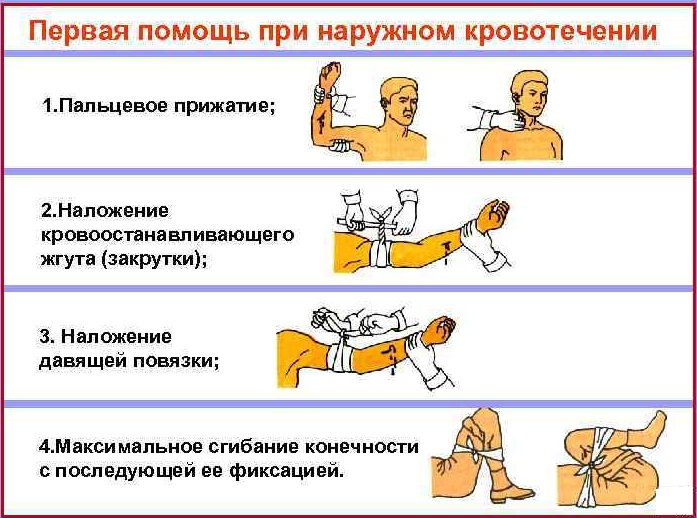 Венозное кровотечение. Признаки, первая помощь, чем характеризуется, как остановить