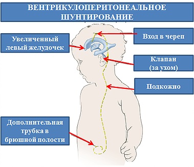 ВЖК 1-2-3 степени у новорожденных. Что это такое, фото, лечение, последствия