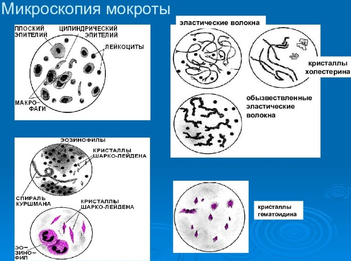 Анализ мокроты. Как сдавать на КУМ, ВК, БК, туберкулез, пневмонию, что это такое, расшифровка