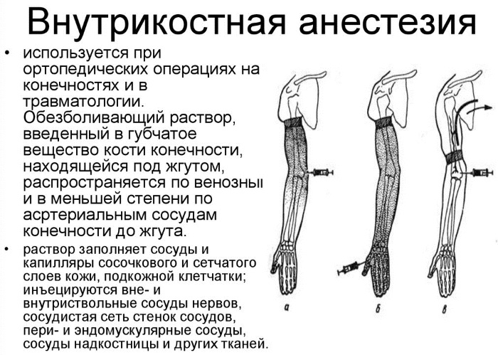 Анестезия инфильтрационная. Техника проведения, препараты, показания, сколько действует