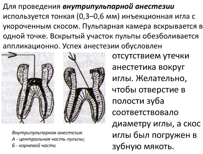 Анестезия инфильтрационная. Техника проведения, препараты, показания, сколько действует