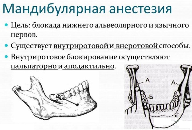 Анестезия инфильтрационная. Техника проведения, препараты, показания, сколько действует