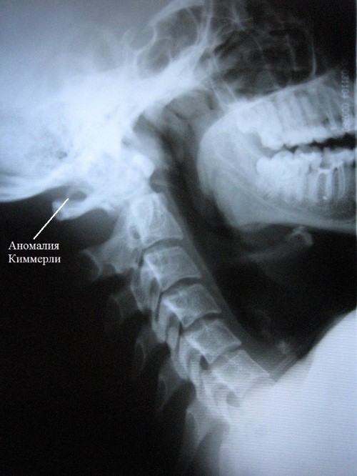 Аномалия Киммерли в шейном отделе позвоночника. Симптомы, лечение, последствия
