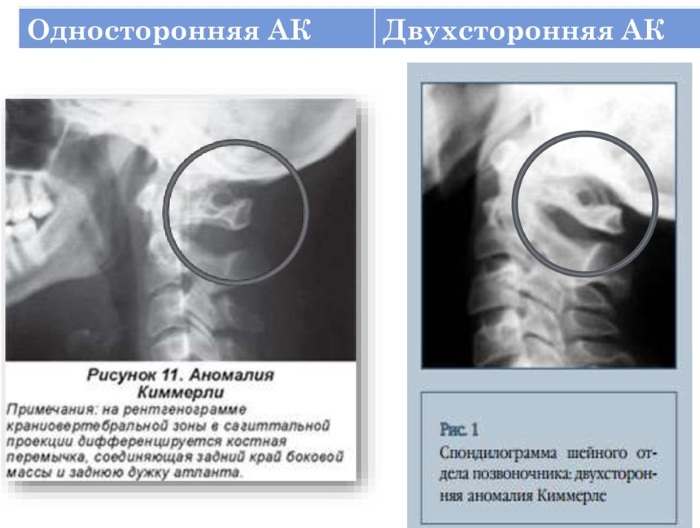 Аномалия Киммерли в шейном отделе позвоночника. Симптомы, лечение, последствия