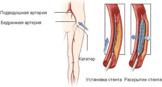 Бедренная артерия. Где находится, анатомия, топография, что кровоснабжает, симптомы болезни, лечение