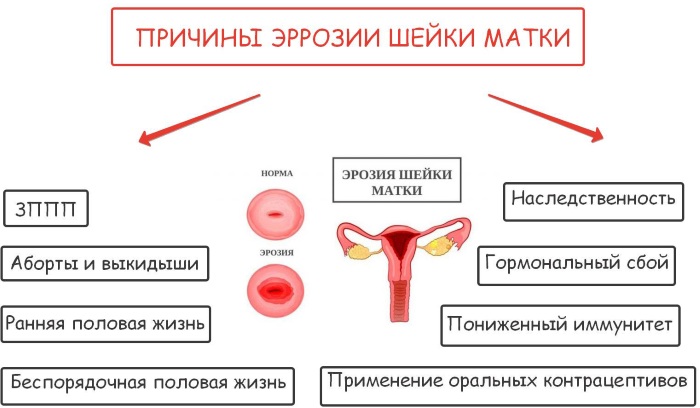 Предраковое состояние шейки матки. Что это такое, название, лечение 1-2-3 степени