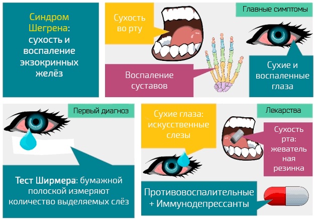 Болезнь Шегрена. Симптомы и лечение, что это такое, клинические рекомендации