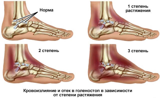 Дельтовидная связка голеностопного сустава. Анатомия, фото, где находится, разрыв, растяжение