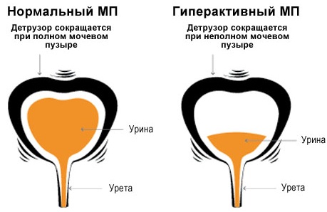 Детрузор мочевого пузыря. Что это такое, симптомы болезни, лечение у женщин, детей, мужчин