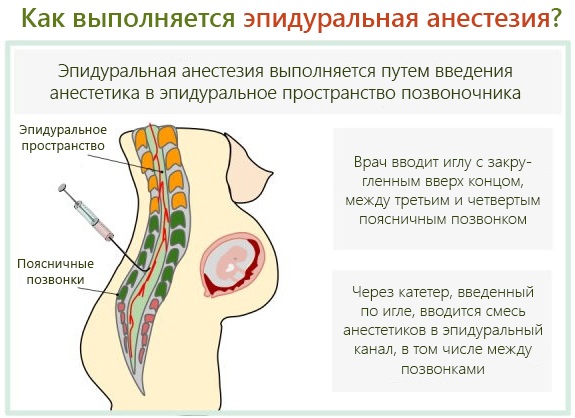 Эпидуралка (эпидуральная анестезия) при родах. Отзывы, что это такое, последствия, противопоказания