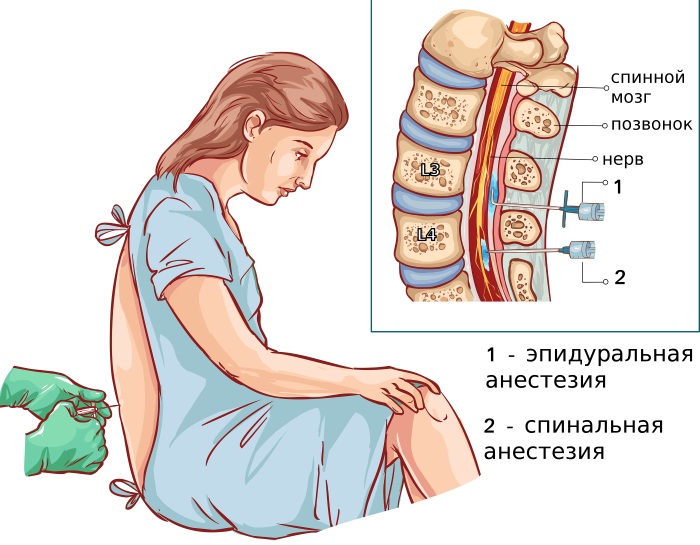 Эпидуралка (эпидуральная анестезия) при родах. Отзывы, что это такое, последствия, противопоказания