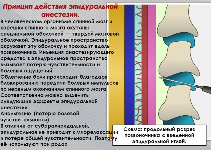 Эпидуралка (эпидуральная анестезия) при родах. Отзывы, что это такое, последствия, противопоказания