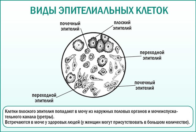 Эпителий в моче фото