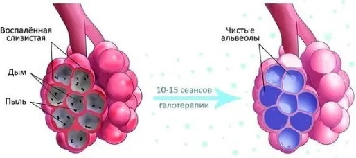 Галокамера. Показания и противопоказания, как проводится процедура, как часто посещать