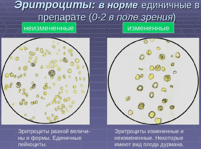 Измененные эритроциты в моче. Что это значит, причины