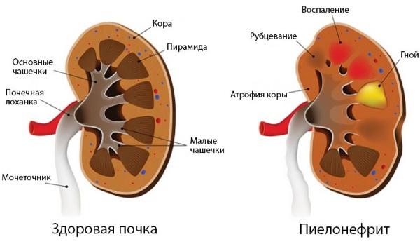 Измененные эритроциты в моче. Что это значит, причины