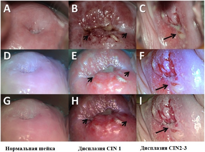 Кольпоскопия шейки матки. Цена, на какой день цикла делать, показания, подготовка, расшифровка