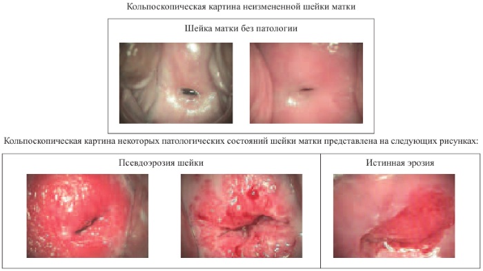 Кольпоскопия шейки матки. Цена, на какой день цикла делать, показания, подготовка, расшифровка