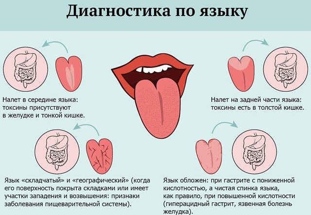 Коричневый налет на языке у взрослых, ребенка. Причины, что это может значить, как избавиться