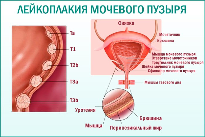 Лейкоплакия мочевого пузыря у женщин, мужчин. Что это такое, симптомы, лечение лазером, антибиотиками